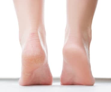 Salep Kaki Pecah Pecah Terbaik